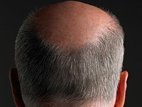 Vertex Baldness and CHD Risk