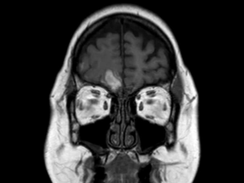 Intracerebral Hemorrhage: The Most Common Causes