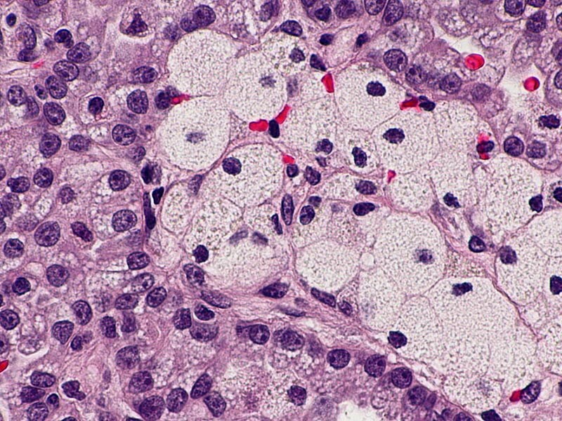 Tailoring Therapy In Renal Cell Carcinoma - Page 2