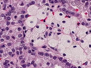 Which Kidney Cancer Drug on Progression? Surprising Answers