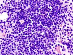 Largest Trial of Transplants in Myeloma: No Need for Extras
