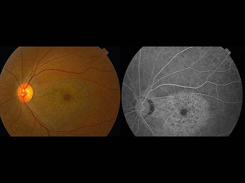 Just How Common Is Hydroxychloroquine Retinopathy