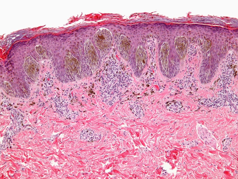 Epidemiological Trends of Cutaneous Malignant Melanoma