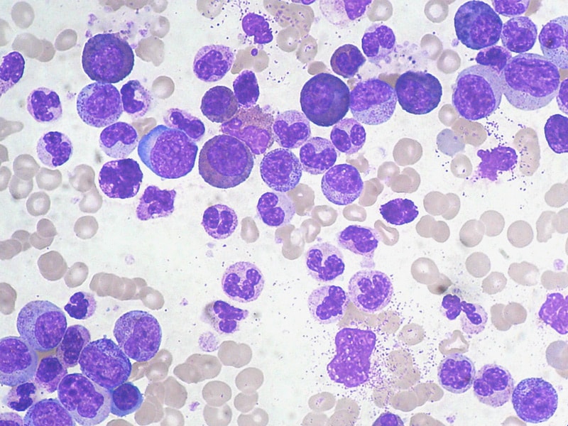 Chemotherapy for Germ Cell Tumor May Spur CML