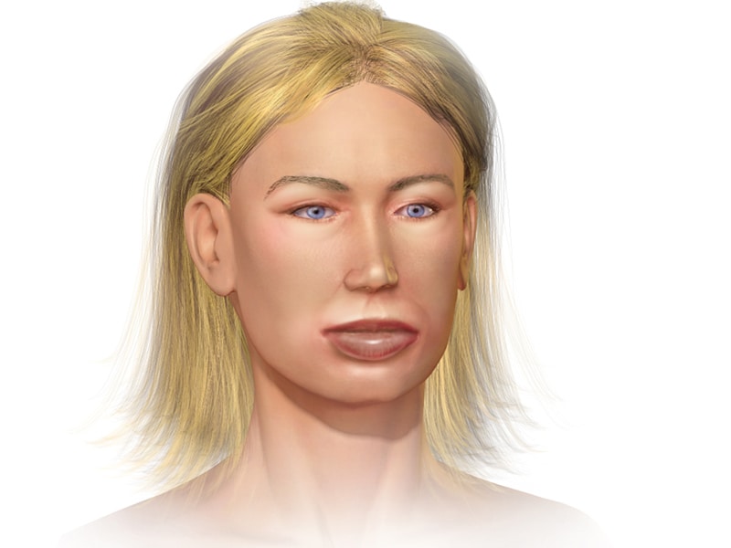 Drug-Induced Angioedema