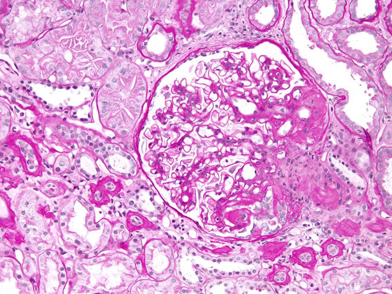 DualPathway Inhibitor Targets Glomerular Disease