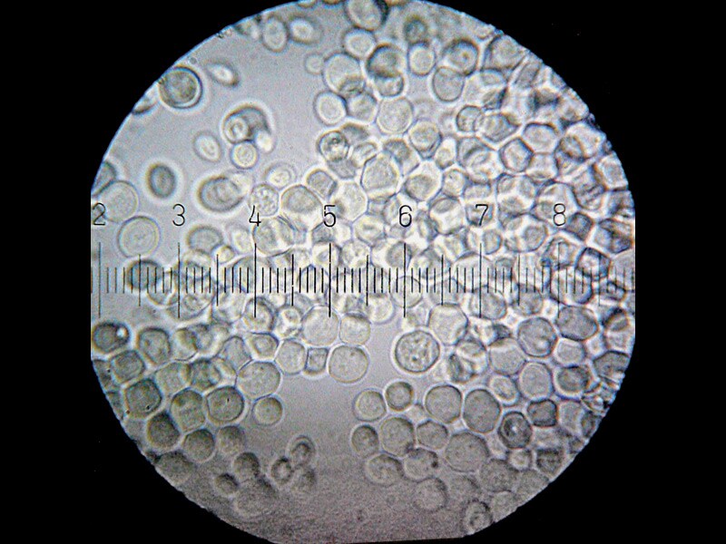 Intestinal Yeast May Aggravate Symptoms of Crohn's Disease