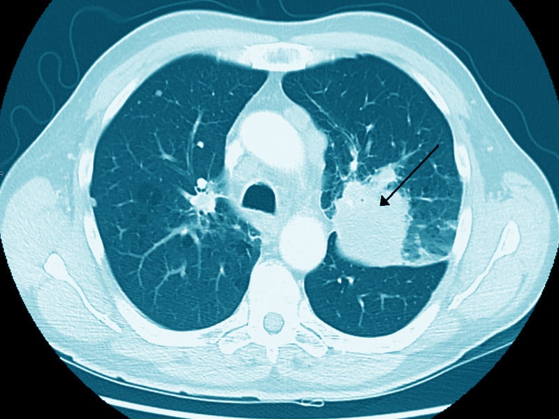 brits-up-cancer-screening-with-mobile-lung-ct-units