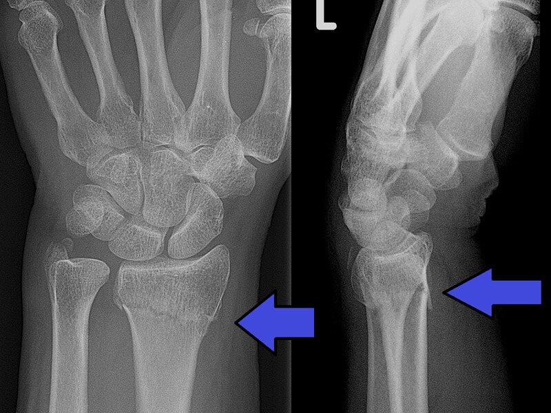 What Is A Hairline Fracture In Wrist