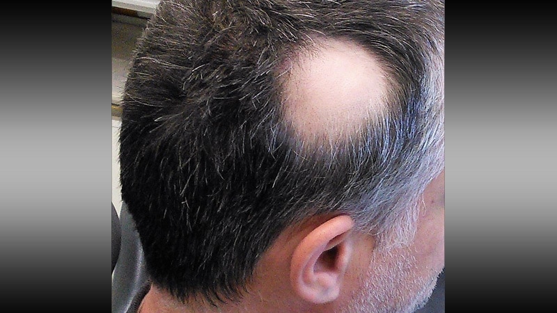 Another JAK Inhibitor Shows Promise For Alopecia Areata   Wc 190311 Alopecia Areata 800x450 