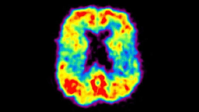Les modèles de prédiction des risques identifient la maladie d’Alzheimer présymptomatique