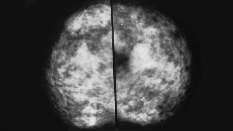 Mri Ups Early Breast Cancer Diagnosis In Women With Dense Breasts 