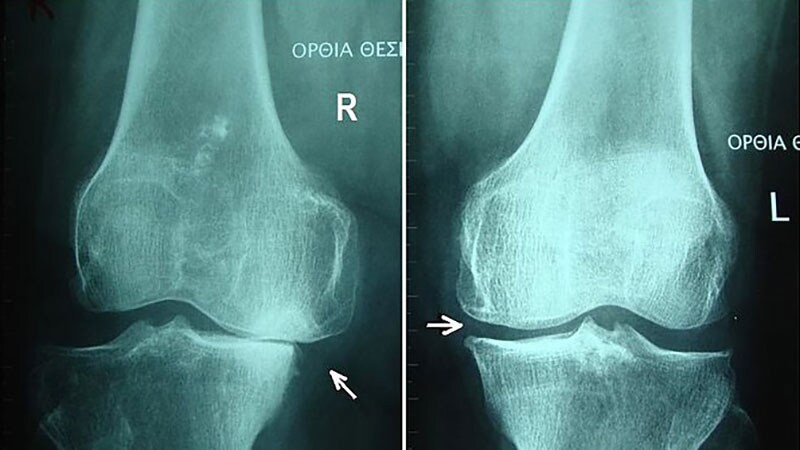 NSAIDs For Knee Osteoarthritis May Worsen Pain Over Time