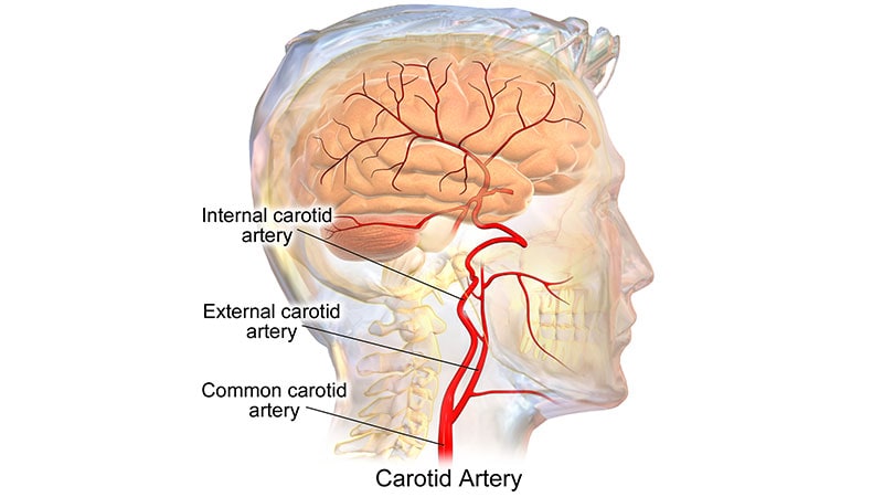 Aucun avantage du bypass EC/IC par rapport aux médicaments dans les accidents vasculaires cérébraux des grosses artères