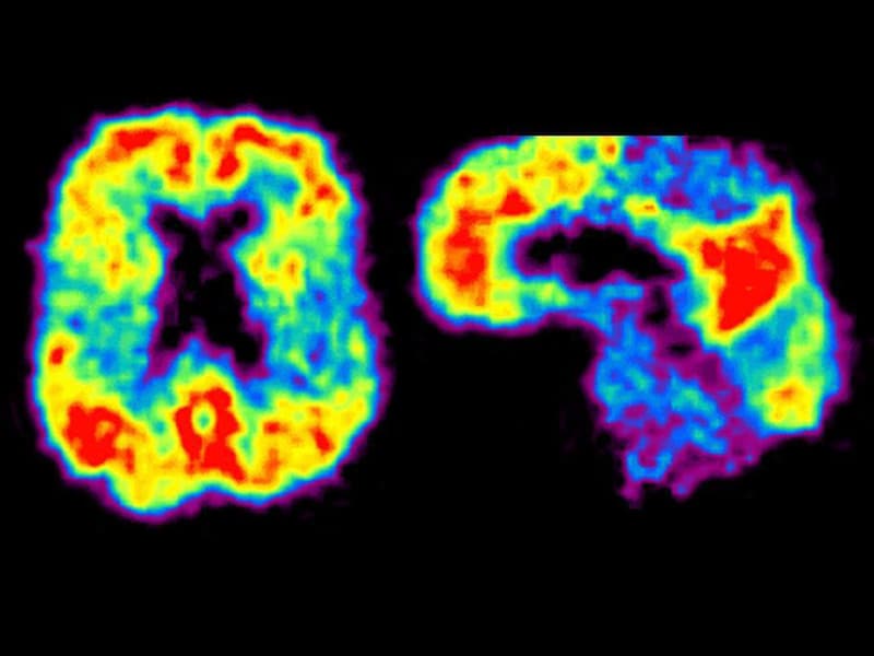 Amyloid Pathology Starts at Age 50, PET Scans Reveal